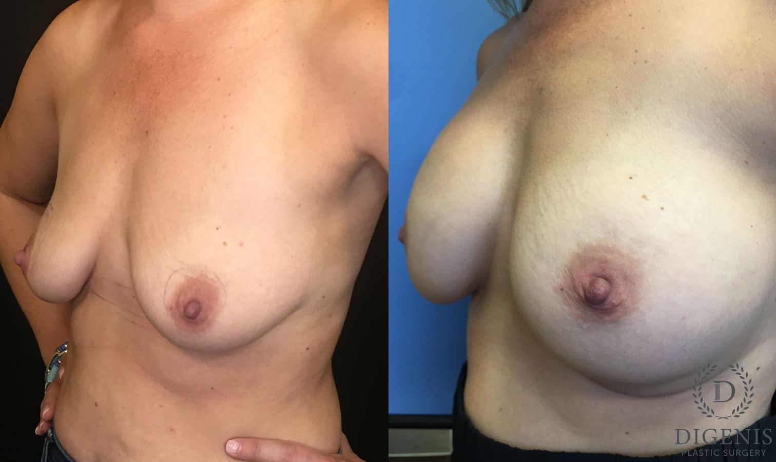 Before and after Breast Lift with or without Implants case 35174 - Angle 4