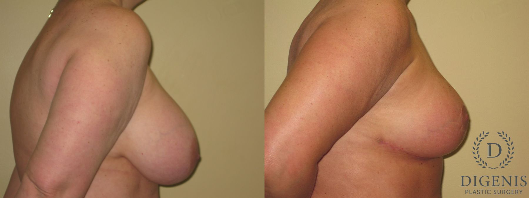 Before and after Breast Lift with or without Implants case 35105 - Angle 3