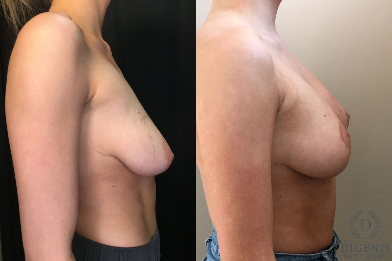 Before and after Breast Lift with or without Implants case 35195 - Angle 3