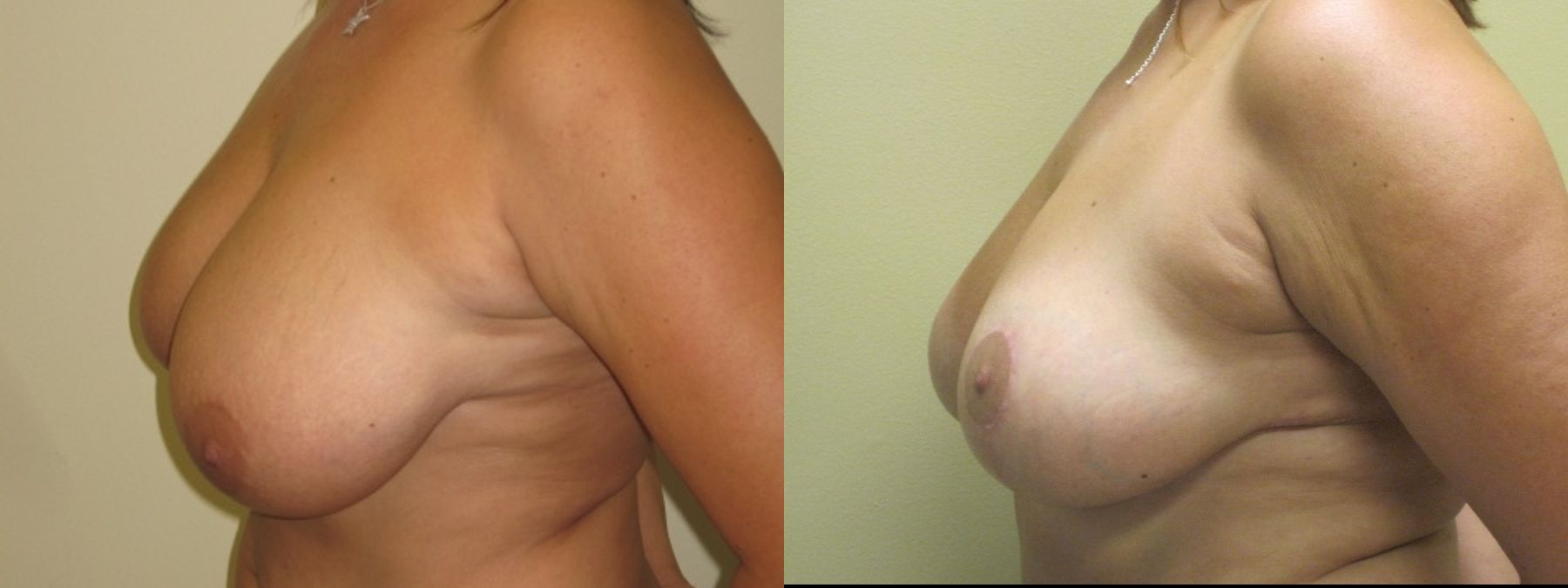 Before and after Breast Lift with or without Implants case 35095 - Angle 5