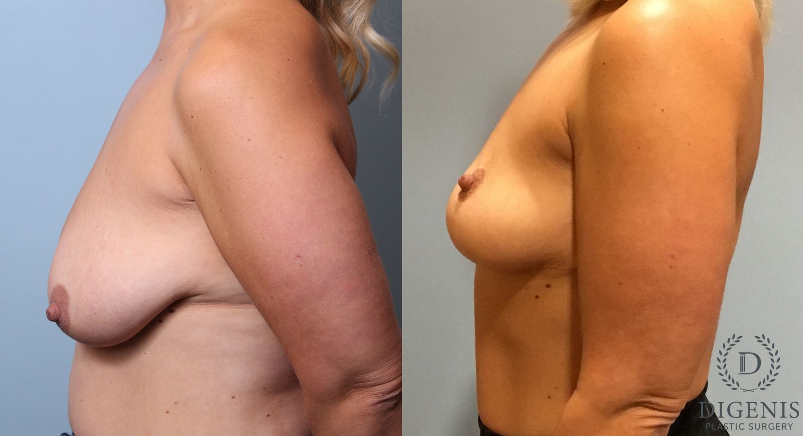 Before and after Breast Lift with or without Implants case 35111 - Angle 5