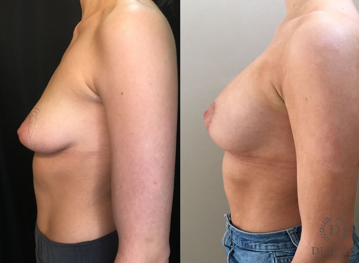Before and after Breast Lift with or without Implants case 35195 - Angle 5