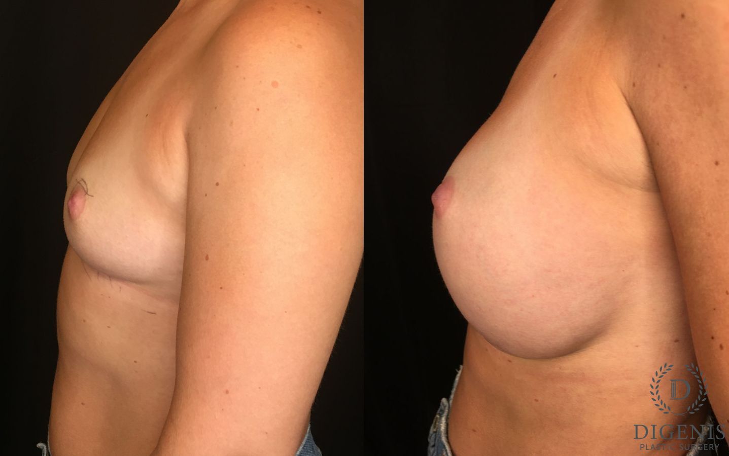 Before and after Breast Lift with or without Implants case 35168 - Angle 5