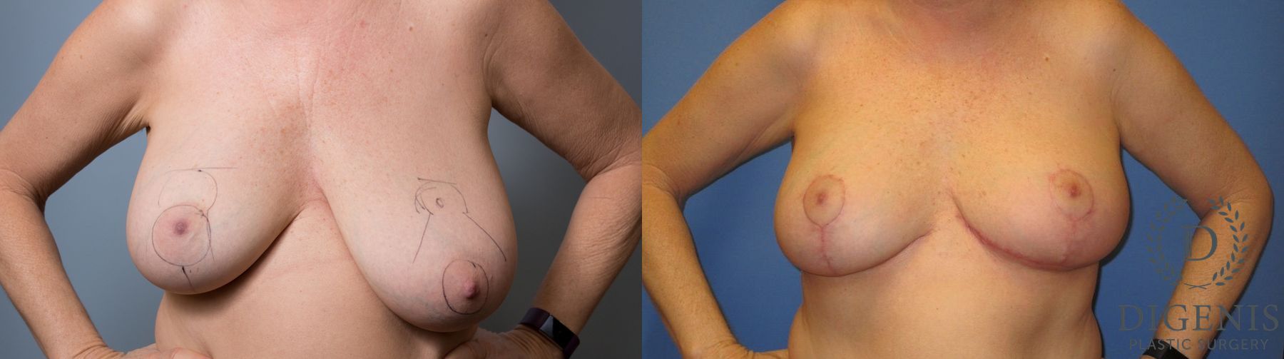 Before and after Breast Lift with or without Implants case 35133
