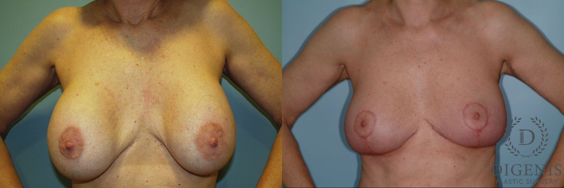 Before and after Breast Lift with or without Implants case 35107