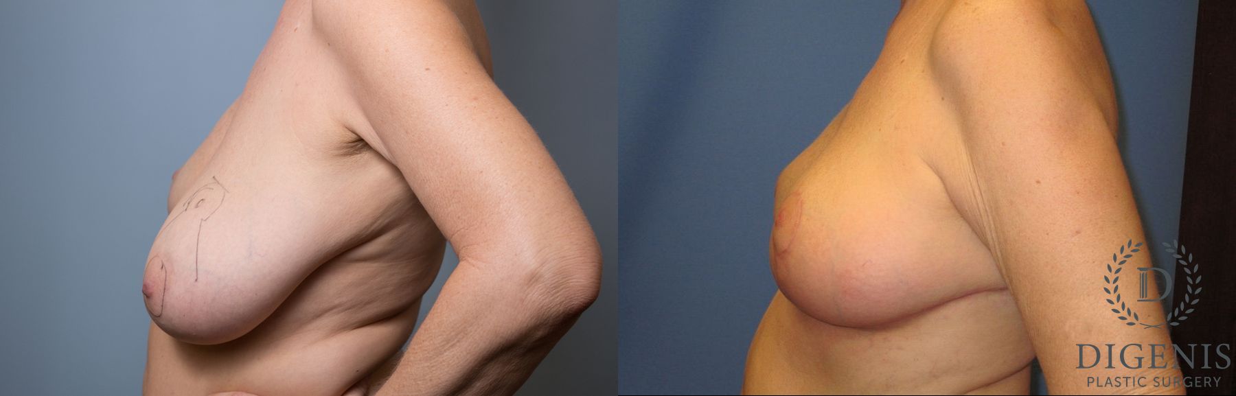 Before and after Breast Lift with or without Implants case 35133 - Angle 5