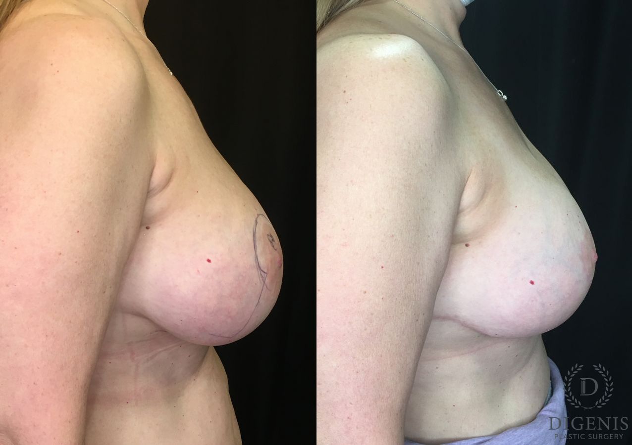 Before and after Breast Lift with or without Implants case 35156 - Angle 3