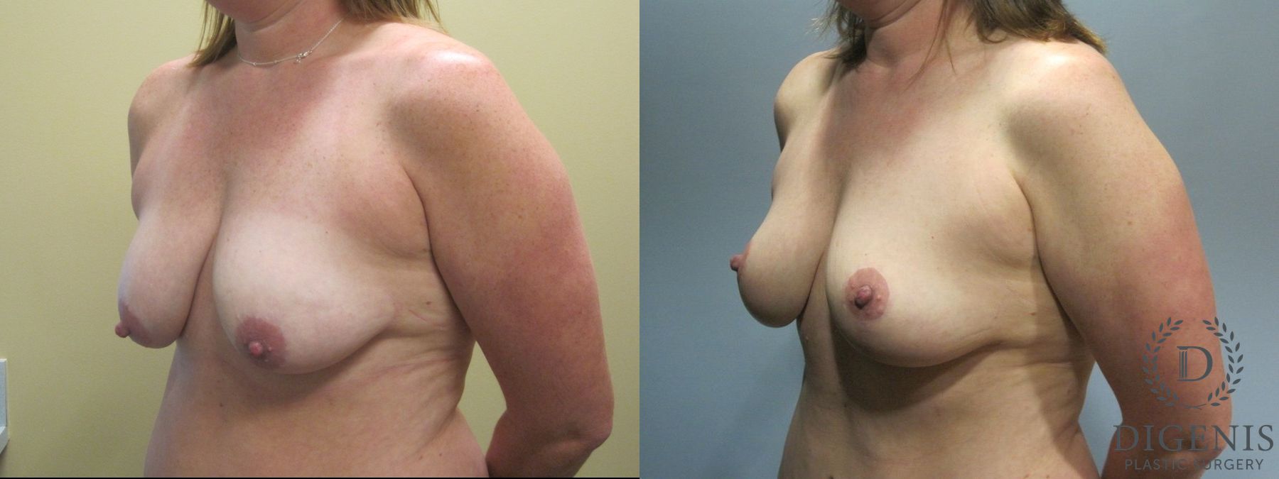 Before and after Breast Lift with or without Implants case 35100 - Angle 4