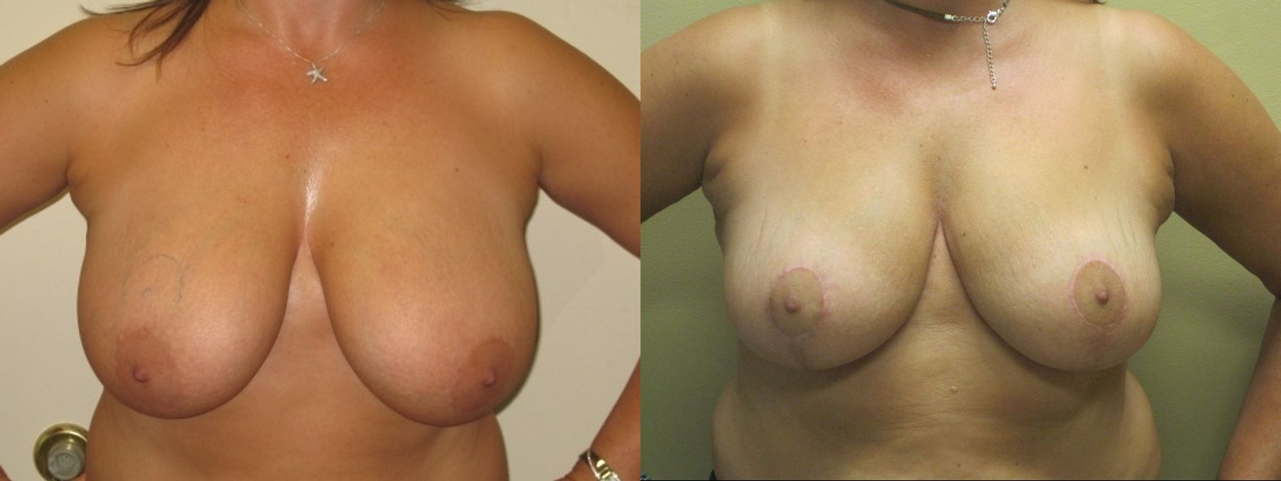 Before and after Breast Lift with or without Implants case 35095