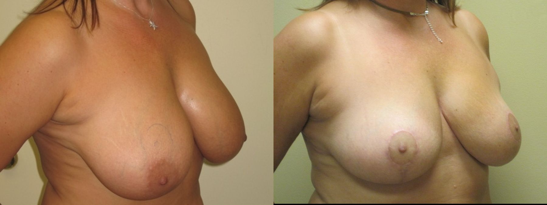 Before and after Breast Lift with or without Implants case 35095 - Angle 2