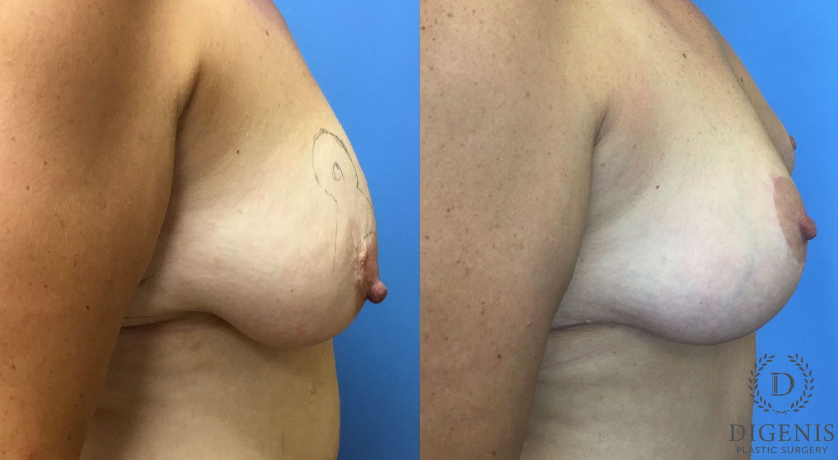 Before and after Breast Lift with or without Implants case 35144 - Angle 3