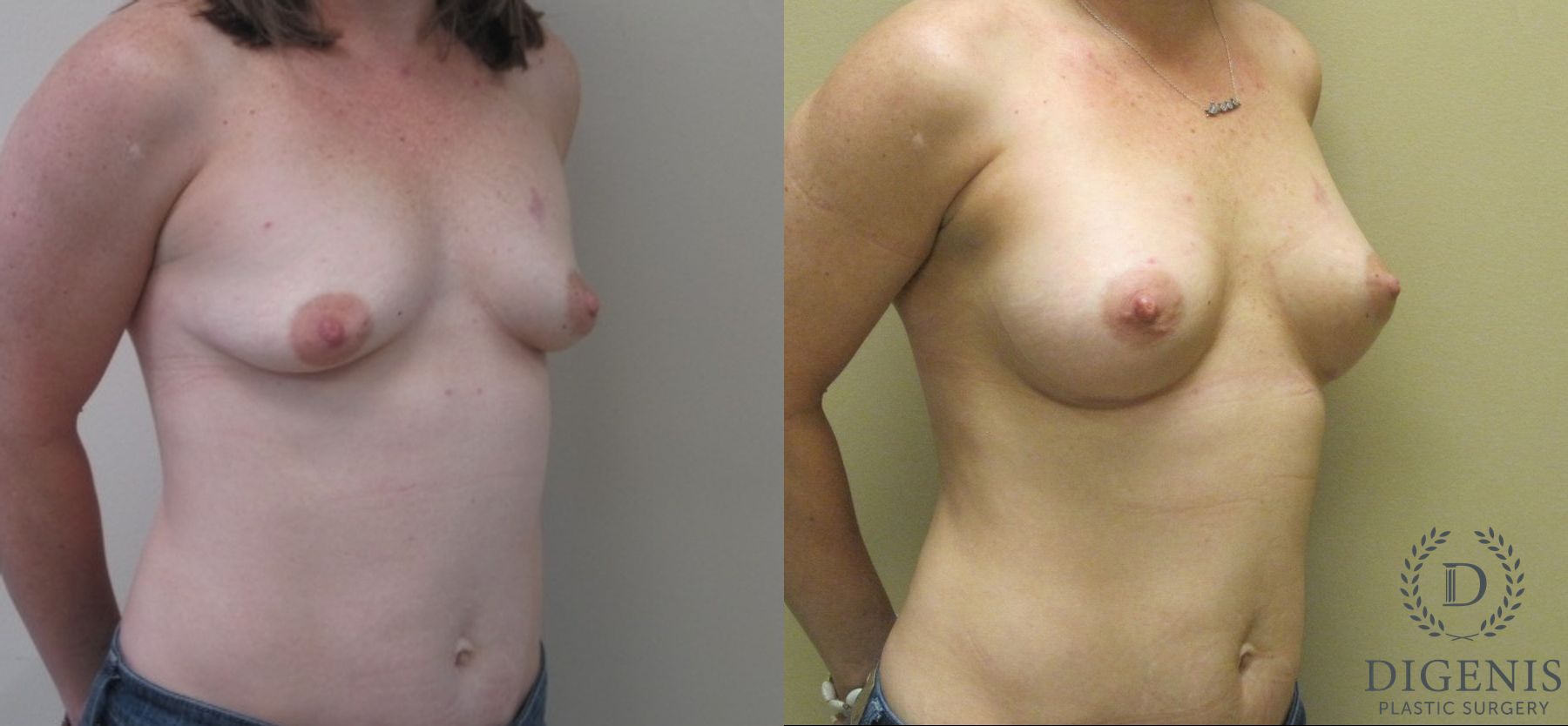 Before and after Breast Lift case 35069 - Angle 2