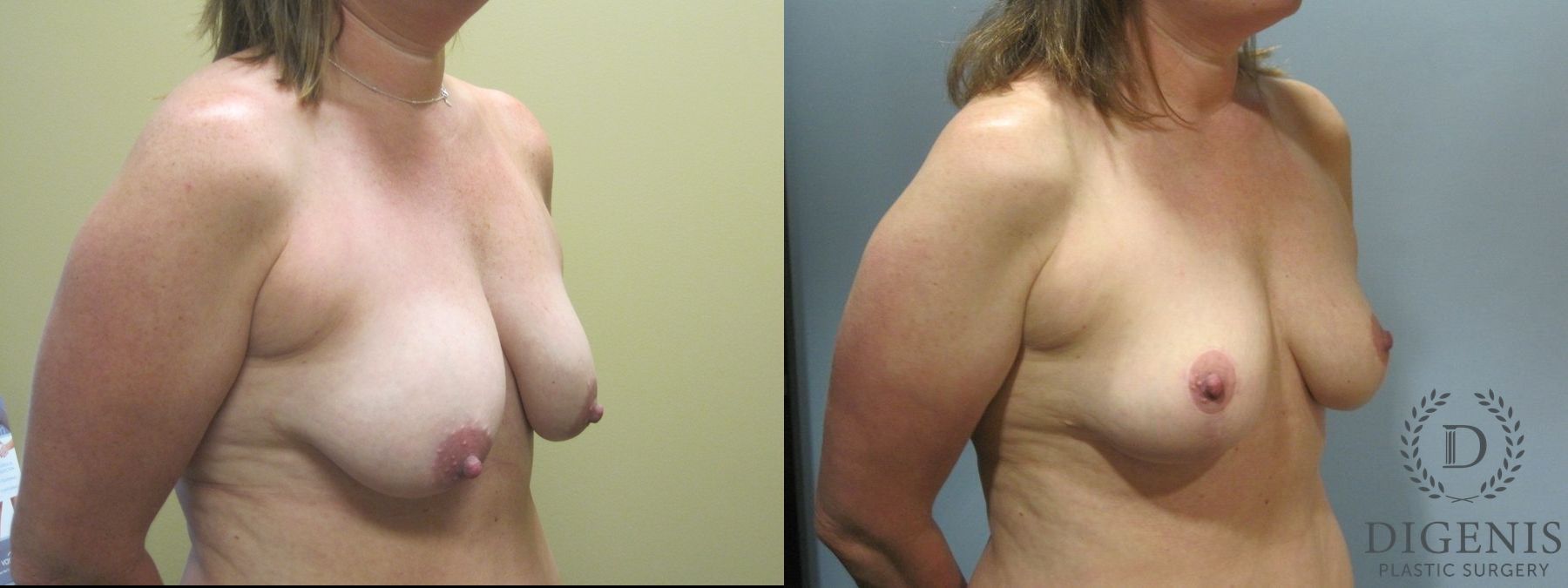 Before and after Breast Lift with or without Implants case 35100 - Angle 2