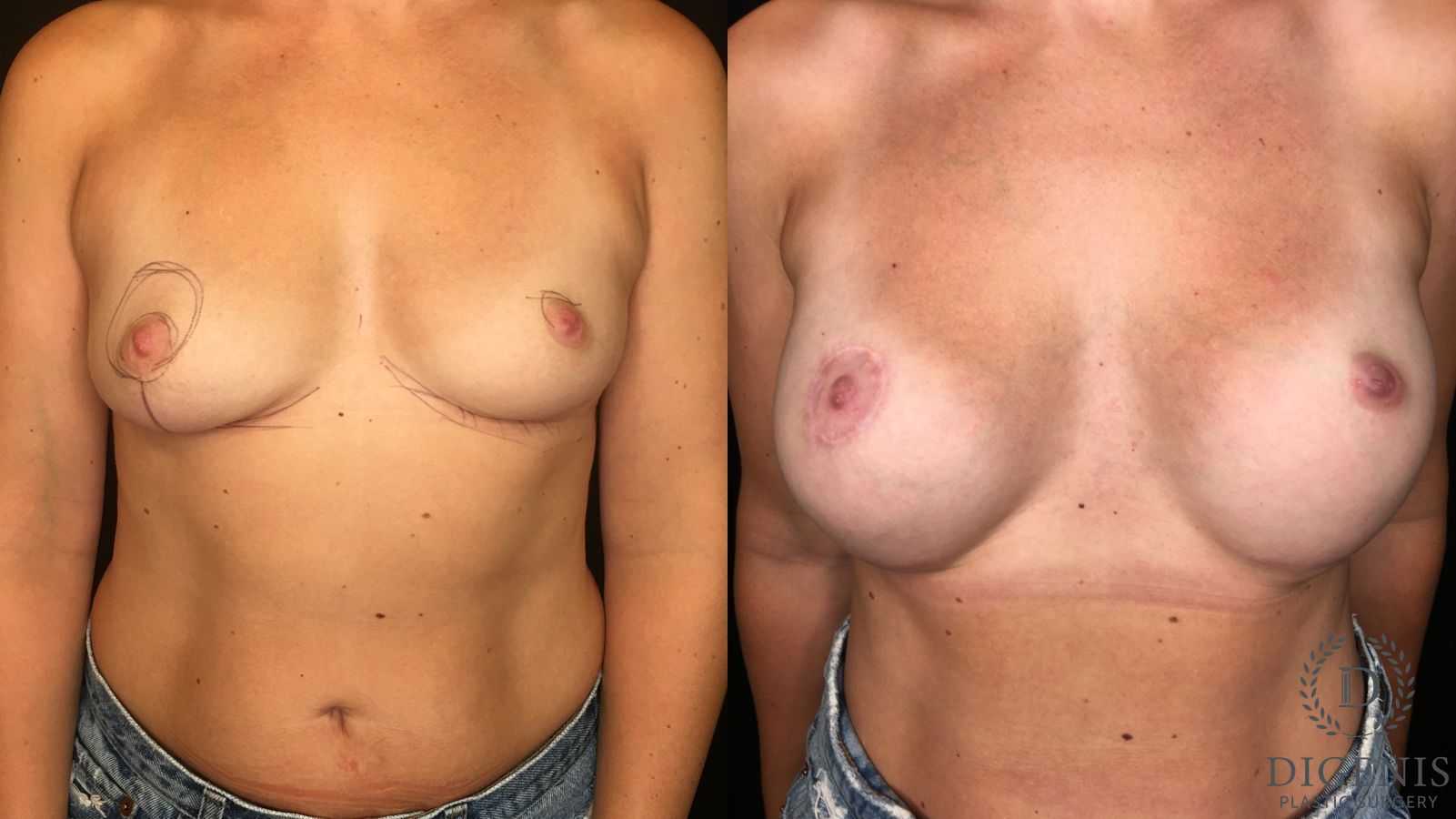 Before and after Breast Lift with or without Implants case 35168