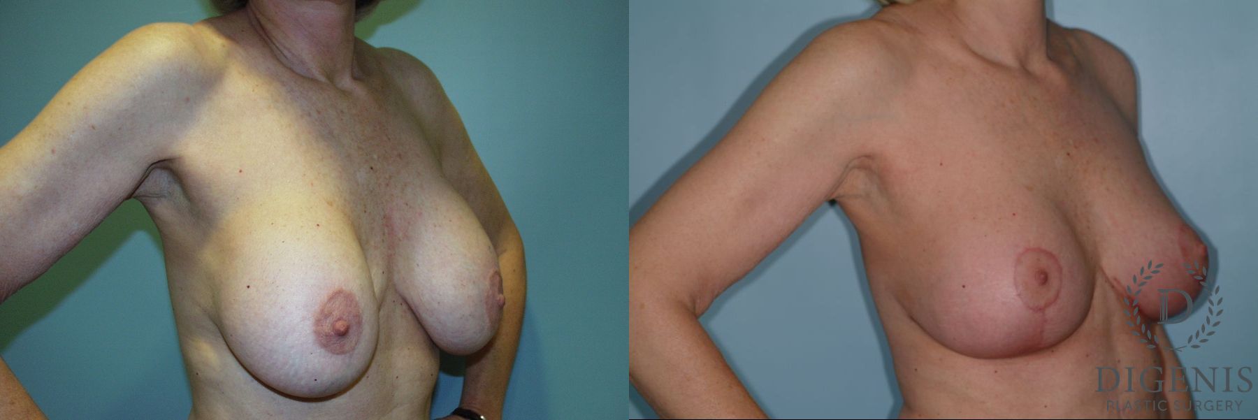 Before and after Breast Lift with or without Implants case 35107 - Angle 2