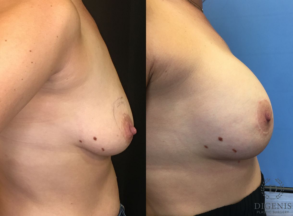 Before and after Breast Lift with or without Implants case 35174 - Angle 3