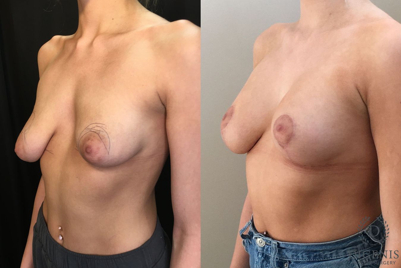 Before and after Breast Lift with or without Implants case 35195 - Angle 4