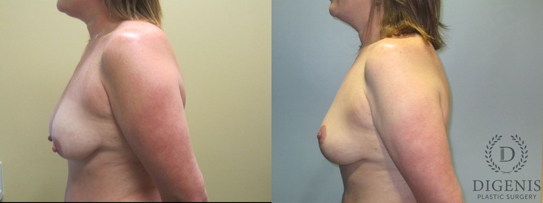 Before and after Breast Lift with or without Implants case 35100 - Angle 5