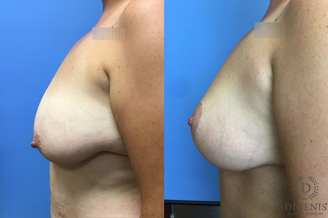 Before and after Breast Lift with or without Implants case 35144 - Angle 5