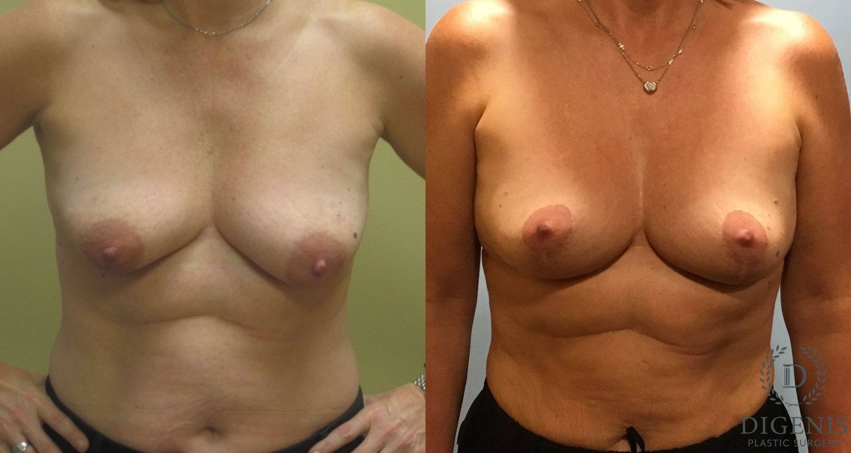 Before and after Breast Lift with or without Implants case 35140