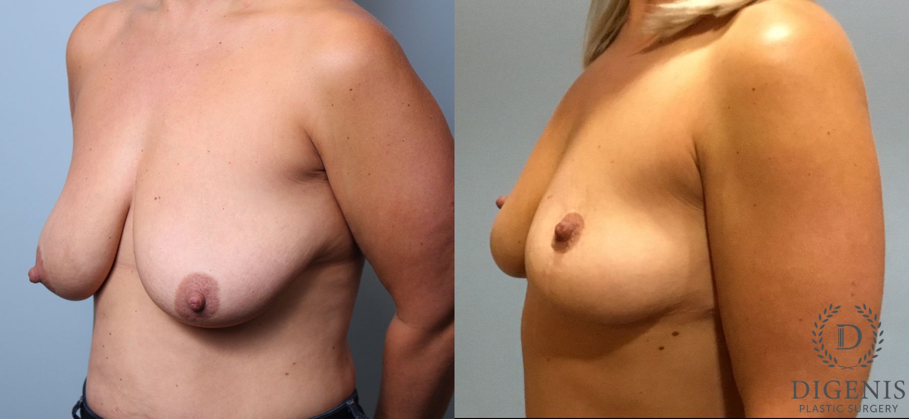 Before and after Breast Lift with or without Implants case 35111 - Angle 4
