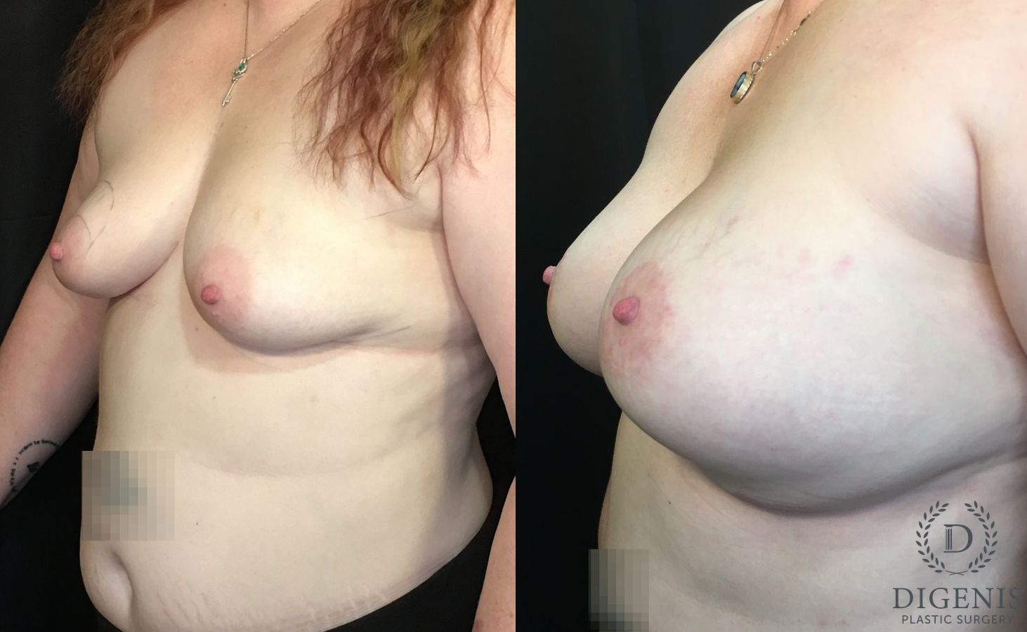 Before and after Breast Lift with or without Implants case 35178 - Angle 4