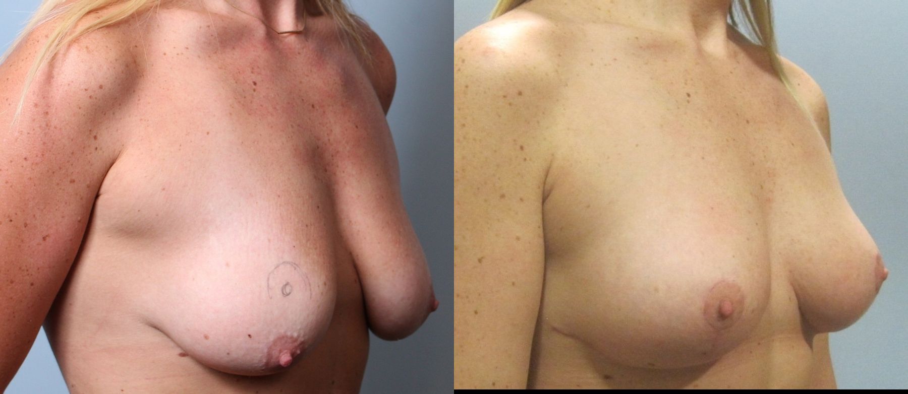 Before and after Breast Lift with or without Implants case 35132 - Angle 2