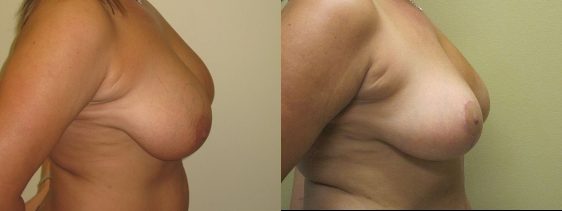 Before and after Breast Lift with or without Implants case 35095 - Angle 3