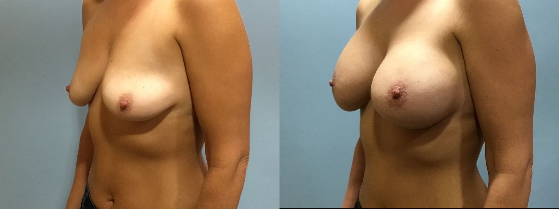 Before and after Breast Lift with or without Implants case 35093 - Angle 4