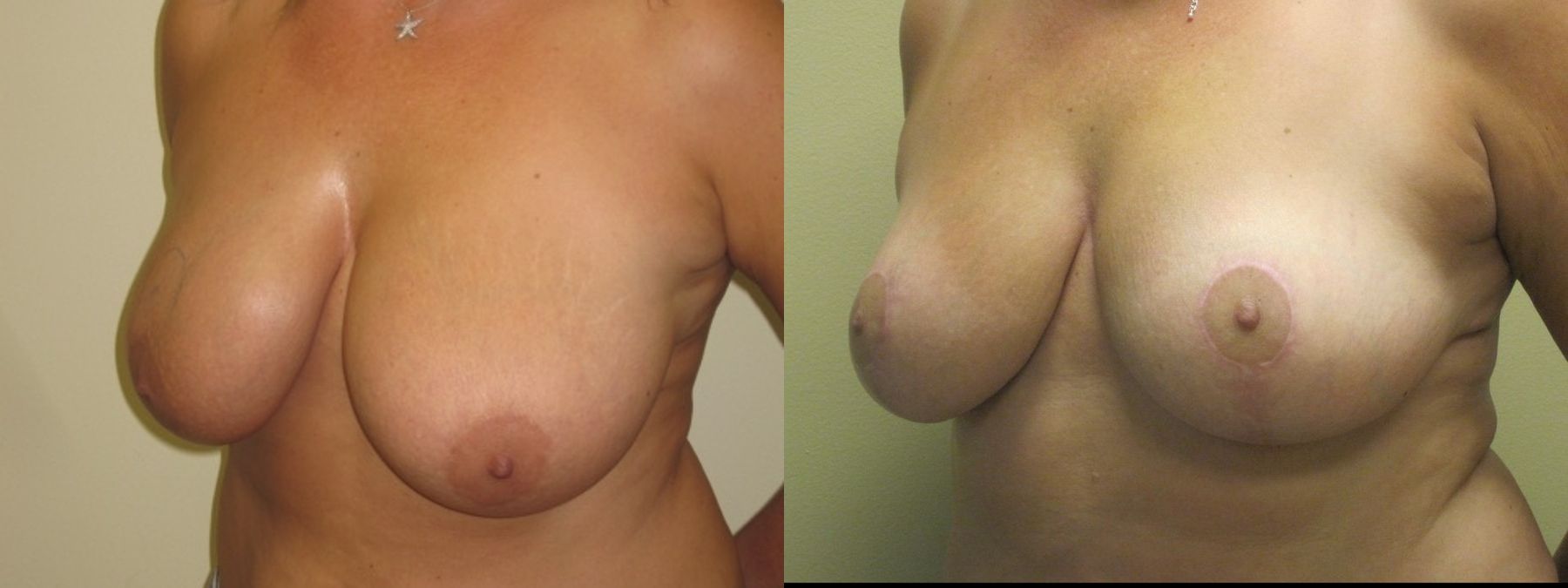 Before and after Breast Lift with or without Implants case 35095 - Angle 4