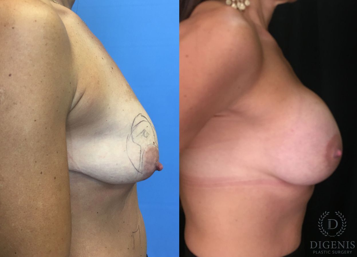 Before and after Breast Lift with or without Implants case 35196 - Angle 3