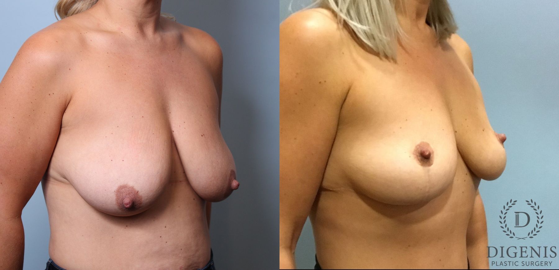 Before and after Breast Lift with or without Implants case 35111 - Angle 2