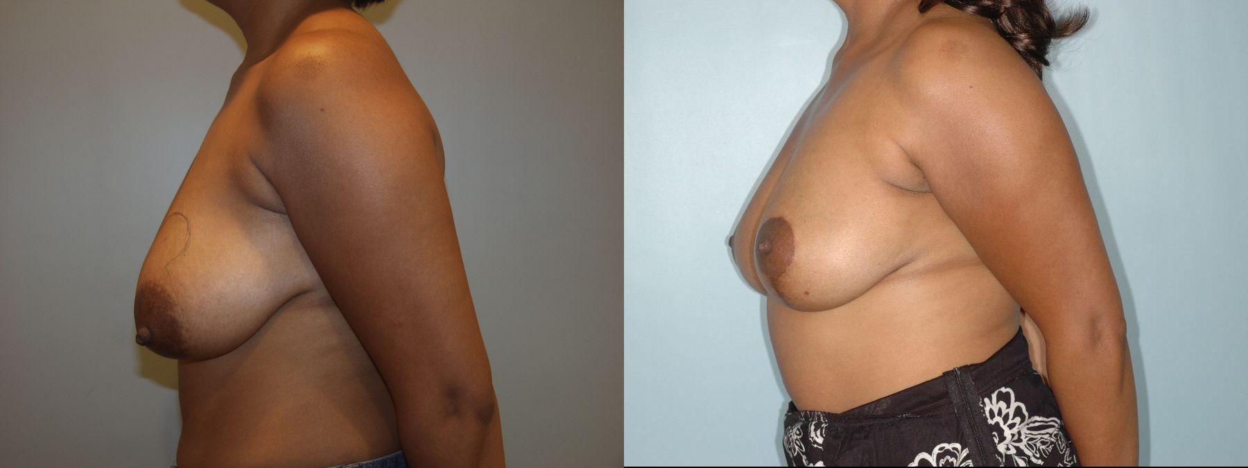 Before and after Breast Lift with or without Implants case 35083 - Angle 3