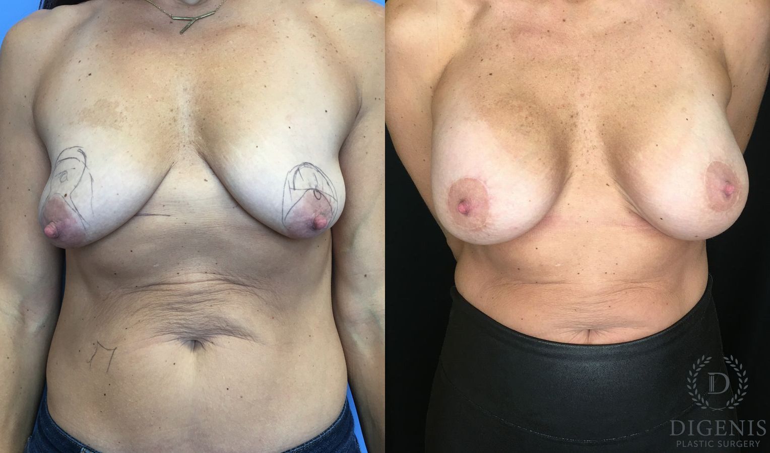 Before and after Breast Lift with or without Implants case 35196