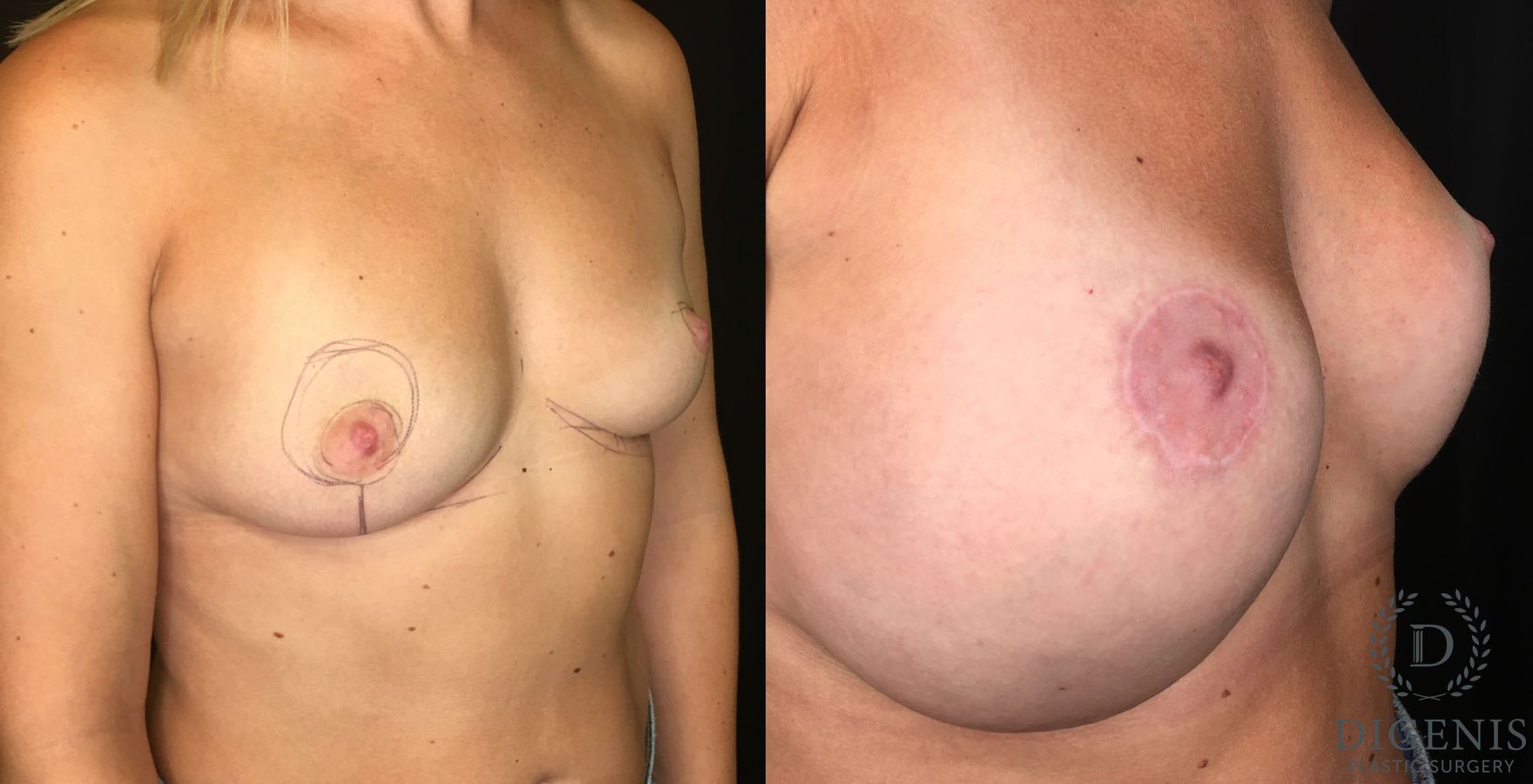 Before and after Breast Lift with or without Implants case 35168 - Angle 2