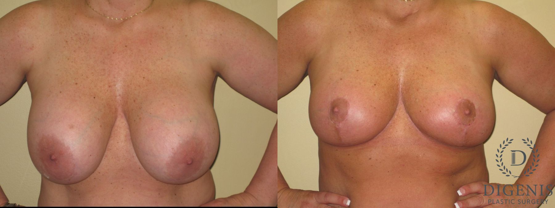 Before and after Breast Lift with or without Implants case 35105