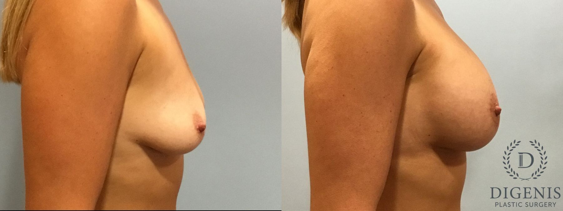 Before and after Breast Lift with or without Implants case 35093 - Angle 3
