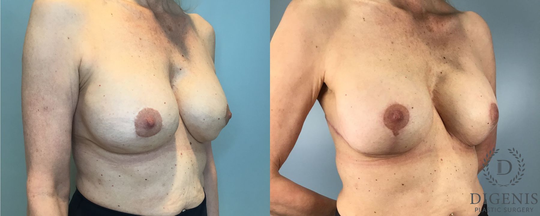 Before and after Breast Lift with or without Implants case 41688 - Angle 4