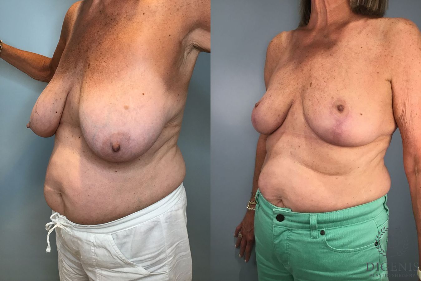 Before and after Breast Lift with or without Implants case 43072 - Angle 2