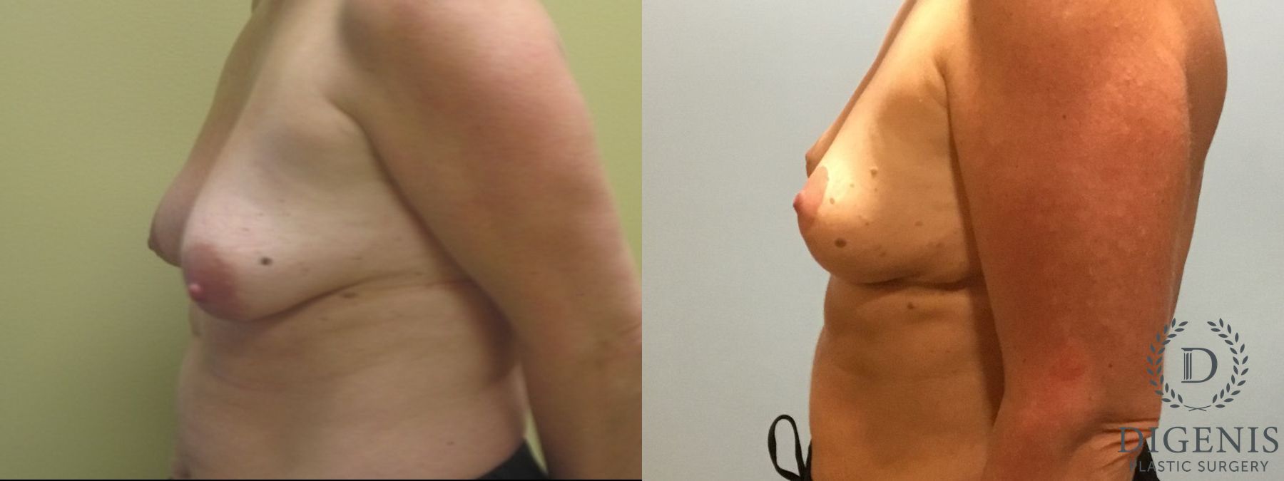 Before and after Breast Lift with or without Implants case 35140 - Angle 5
