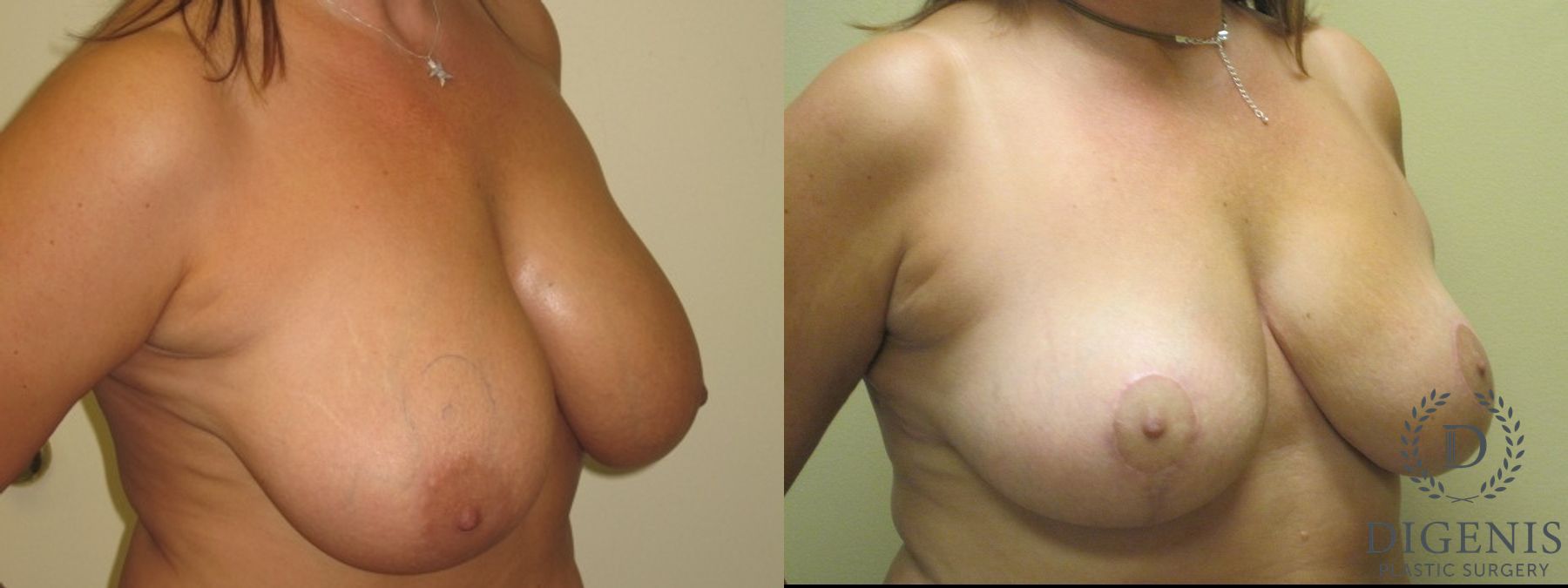 Before and after Breast Lift with or without Implants case 35095 - Angle 2