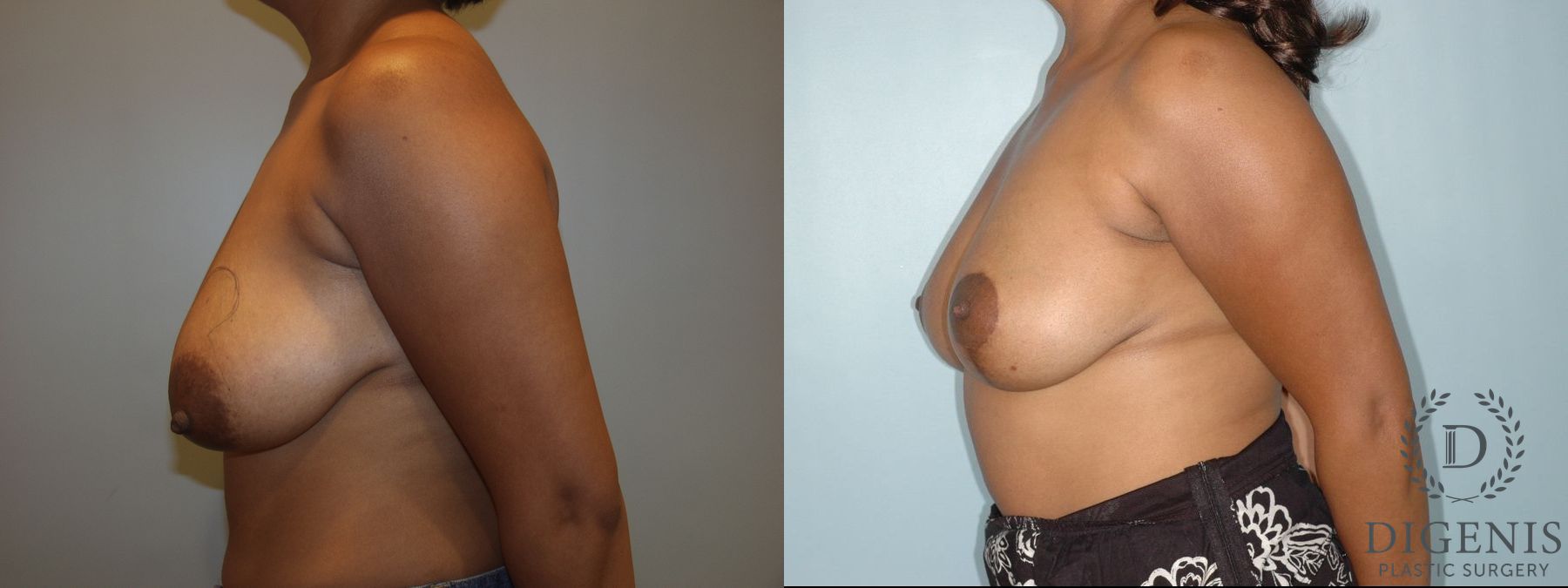 Before and after Breast Lift with or without Implants case 35083 - Angle 3