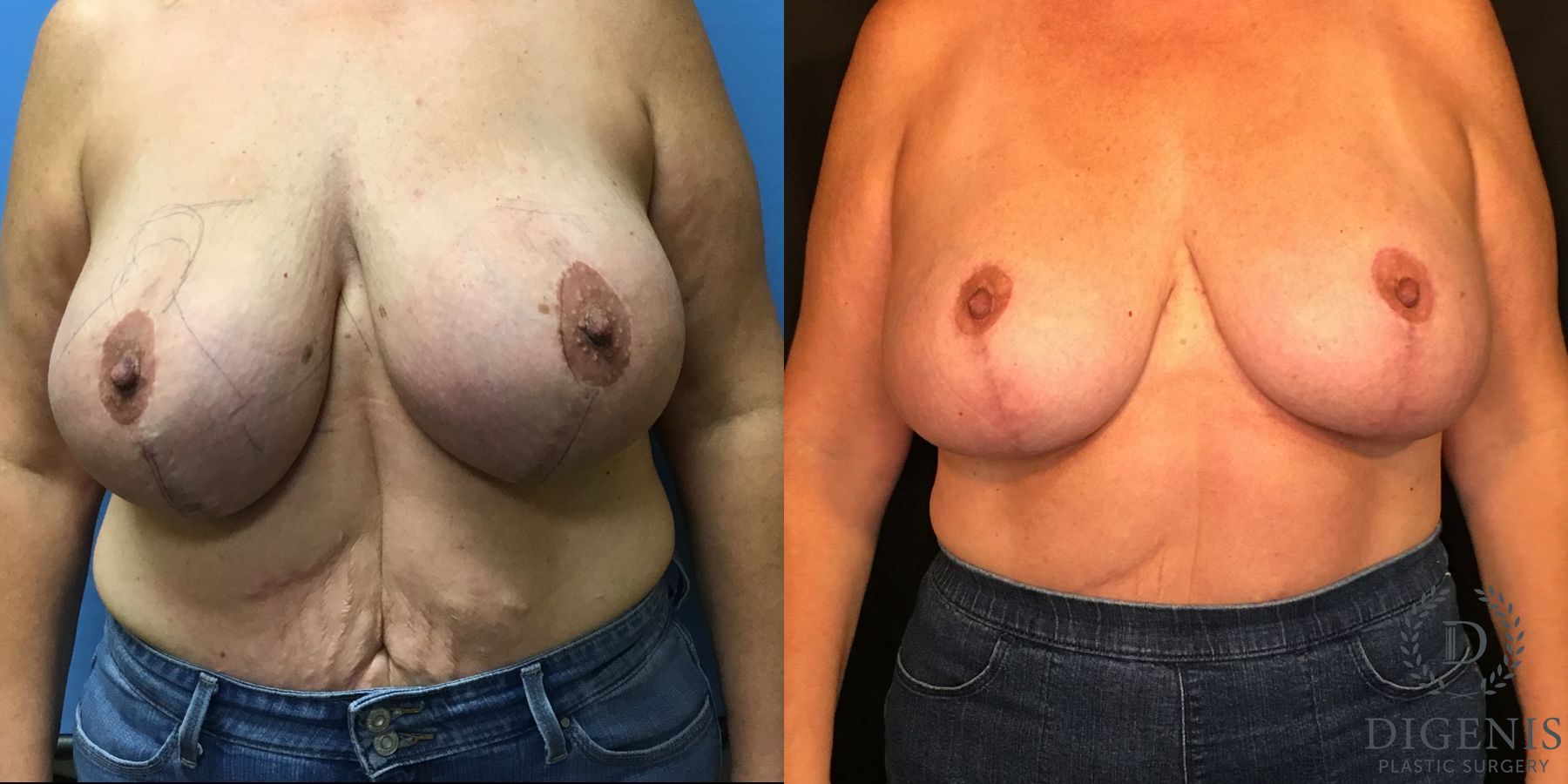 Before and after Breast Lift with or without Implants case 35088
