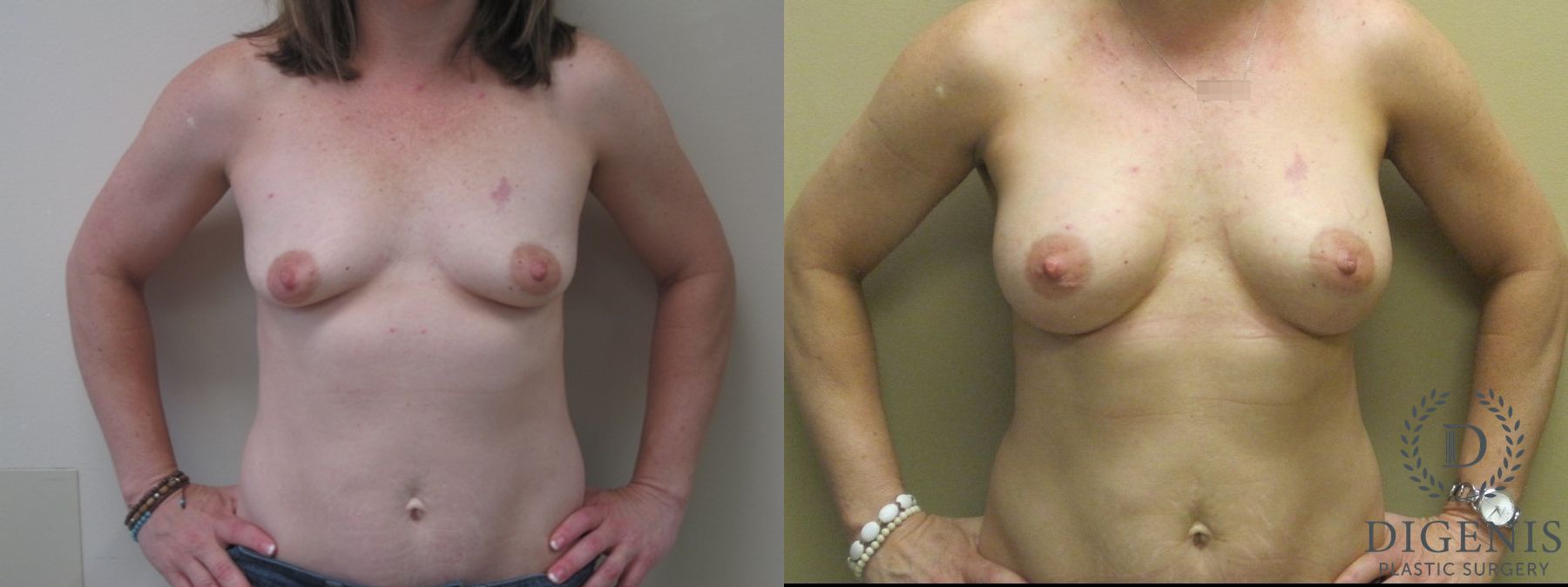 Before and after Breast Lift with or without Implants case 35069