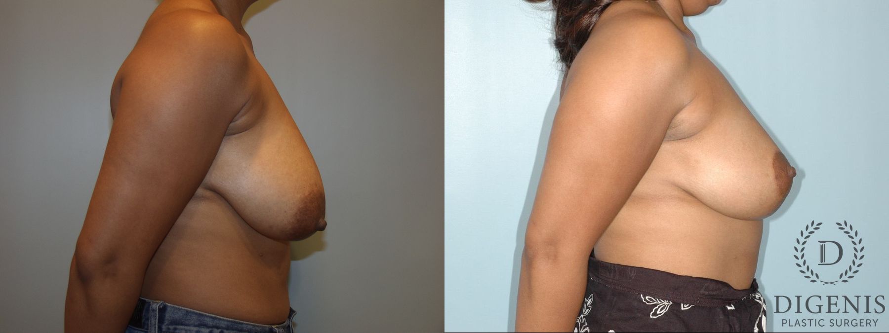 Before and after Breast Lift with or without Implants case 35083 - Angle 2