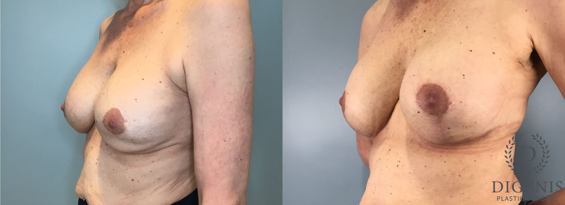 Before and after Breast Lift with or without Implants case 41688 - Angle 2