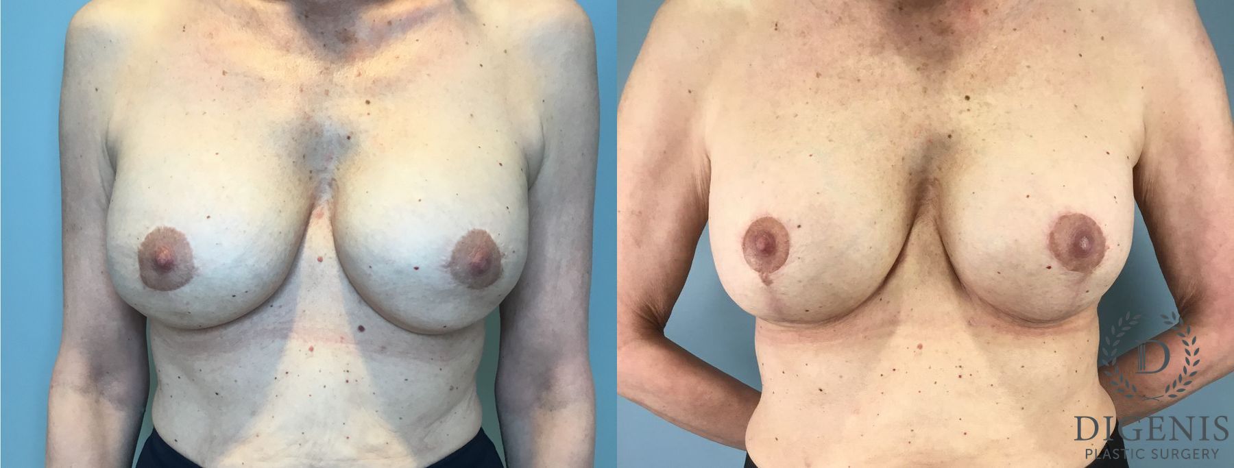 Before and after Breast Lift with or without Implants case 41688