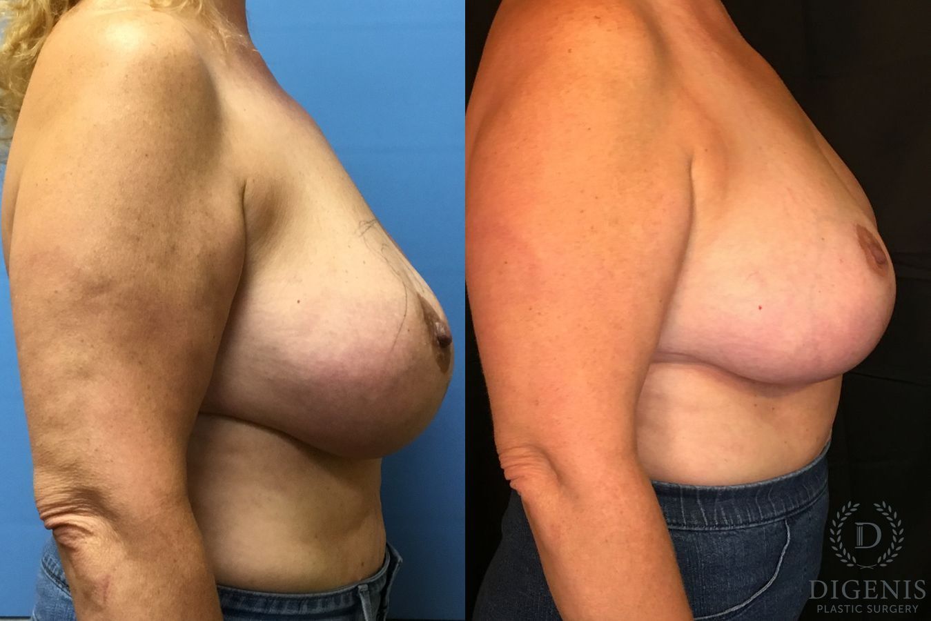 Before and after Breast Lift with or without Implants case 35088 - Angle 3