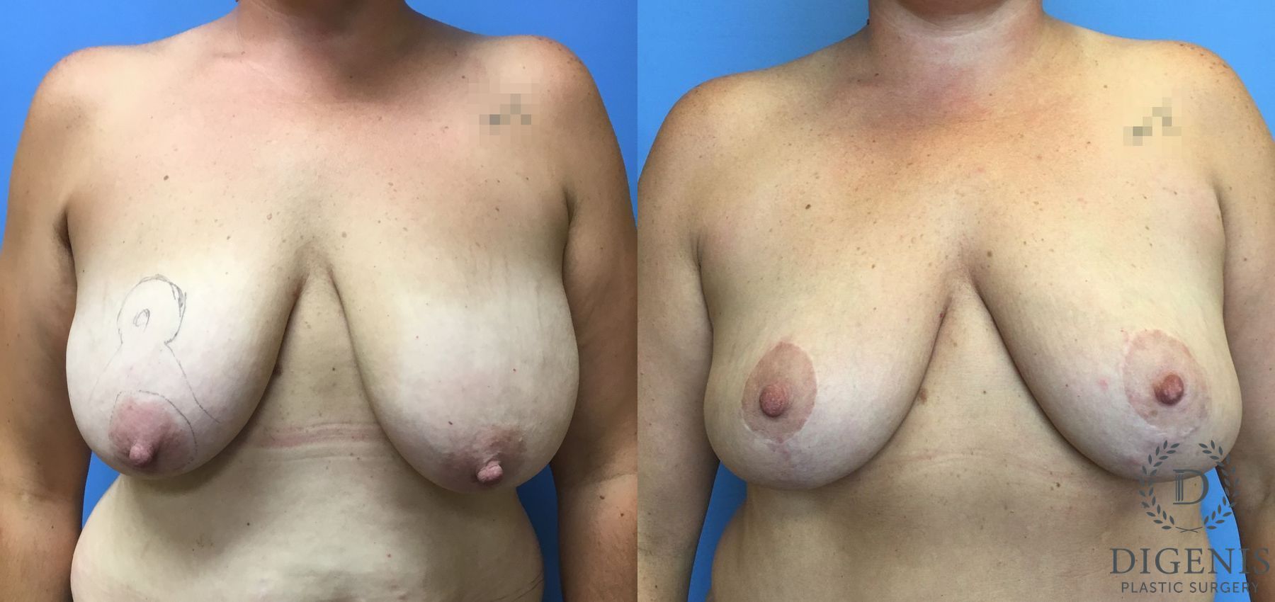 Before and after Breast Lift with or without Implants case 35144