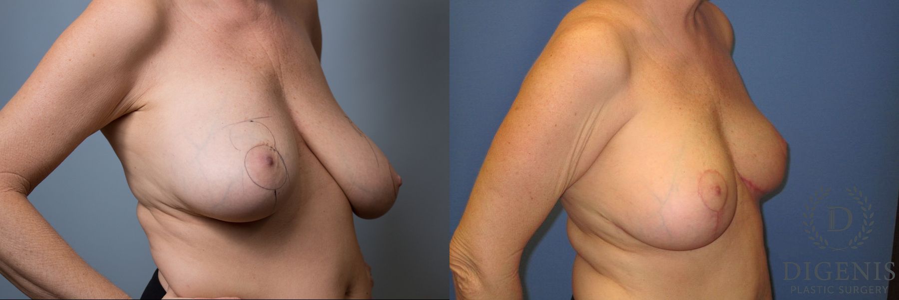 Before and after Breast Lift with or without Implants case 35133 - Angle 2